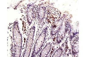 Formalin-fixed and paraffin embedded human colon labeled with Anti-DR3/APO3/TWEAK Polyclonal Antibody, Unconjugated  at 1:200, followed by conjugation to the secondary antibody and DAB staining (DR3/LARD antibody  (AA 351-417))