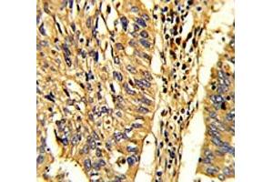 IHC analysis of FFPE human lung carcinoma with HSP60 antibody (HSPD1 antibody  (AA 80-109))
