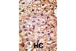 Formalin-fixed and paraffin-embedded human hepatocellular carcinoma tissue reacted with ACE2 polyclonal antibody  , which was peroxidase-conjugated to the secondary antibody, followed by AEC staining. (ACE2 antibody  (AA 59-90))