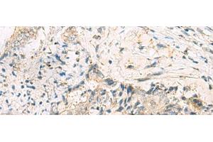 Immunohistochemistry of paraffin-embedded Human cervical cancer tissue using MGAT4B Polyclonal Antibody at dilution of 1:50(x200) (MGAT4B antibody)