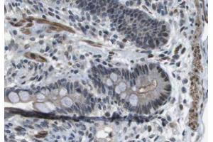 ABIN6266623 at 1/100 staining human colon carcinoma tissue sections by IHC-P. (Peripherin antibody  (C-Term))