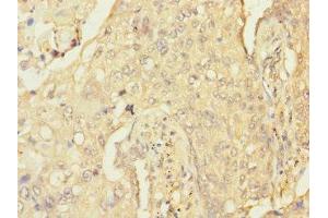 Immunohistochemistry of paraffin-embedded human lung cancer using ABIN7167625 at dilution of 1:100 (RGS antibody  (AA 230-350))