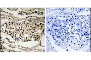Immunohistochemistry analysis of paraffin-embedded human breast carcinoma, using NF-kappaB p65 (Phospho-Ser281) Antibody.