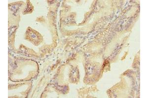 Immunohistochemistry of paraffin-embedded human prostate cancer using ABIN7177750 at dilution of 1:100 (Plet1 antibody  (AA 28-218))