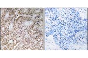 Immunohistochemistry analysis of paraffin-embedded human colon carcinoma tissue, using UBQLN4 Antibody. (UBQLN4 antibody  (AA 201-250))