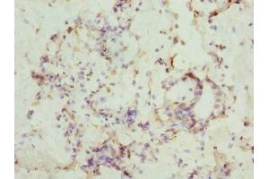 Immunohistochemistry of paraffin-embedded human breast cancer using ABIN7146874 at dilution of 1:100 (CSNK1G1 antibody  (Isoform gamma 1))