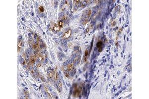 ABIN6277386 at 1/100 staining human Prostate cancer tissue sections by IHC-P.