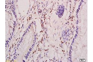 Formalin-fixed and paraffin embedded human colon carcinoma tissue labeled with Anti CIP2A/p90 Autoantigen Polyclonal Antibody,Unconjugated (ABIN760241) at 1:200 followed by conjugation to the secondary antibody and DAB staining. (KIAA1524 antibody  (AA 601-700))