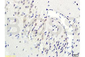 Formalin-fixed and paraffin-embedded human colon carcinoma labeled with Rabbit Anti-GRB2/ASH Polyclonal Antibody (ABIN686932) , Unconjugated 1:200 followed by conjugation to the secondary antibody and DAB staining (GRB2 antibody)