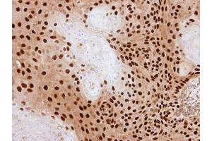 IHC-P Image Immunohistochemical analysis of paraffin-embedded SAS xenograft, using PDE6D, antibody at 1:500 dilution. (PDE6D antibody  (full length))