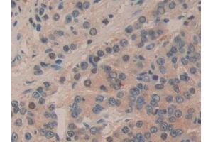 Detection of mTOR in Human Prostate cancer Tissue using Polyclonal Antibody to Serine/threonine-protein kinase mTOR (mTOR) (MTOR antibody  (AA 2226-2488))
