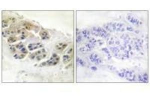 Immunohistochemistry analysis of paraffin-embedded human breast carcinoma tissue using Mammaglobin antibody. (Mammaglobin A antibody)
