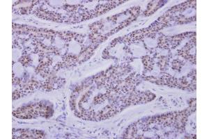 IHC-P Image CaMK1D antibody detects CAMK1D protein at nucleus on human breast cancer by immunohistochemical analysis.