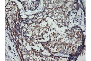 Immunohistochemical staining of paraffin-embedded Adenocarcinoma of Human breast tissue using anti-ERBB2 mouse monoclonal antibody. (ErbB2/Her2 antibody  (AA 676-1255))