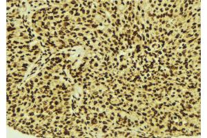 ABIN6274515 at 1/100 staining Human breast cancer tissue by IHC-P. (LASS4 antibody  (N-Term))