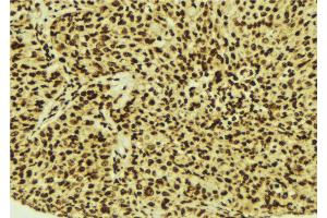 ABIN6274515 at 1/100 staining Human breast cancer tissue by IHC-P.
