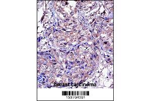 MMP11 Antibody immunohistochemistry analysis in formalin fixed and paraffin embedded human breast carcinoma followed by peroxidase conjugation of the secondary antibody and DAB staining.