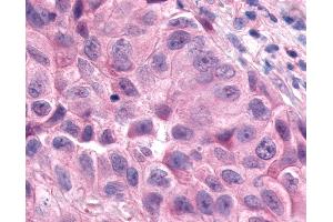 Anti-ESRRA / ERR Alpha antibody IHC of human Lung, Non-Small Cell Carcinoma. (ESRRA antibody  (Internal Region))