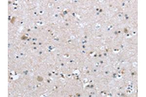 The image on the left is immunohistochemistry of paraffin-embedded Human brain tissue using ABIN7192921(TRPM3 Antibody) at dilution 1/20, on the right is treated with synthetic peptide. (TRPM3 antibody)