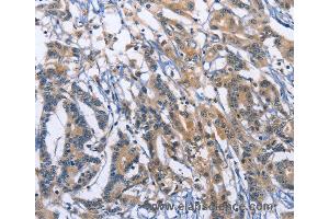 Immunohistochemistry of Human colon cancer using SYT17 Polyclonal Antibody at dilution of 1:60 (SYT17 antibody)