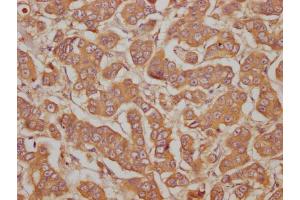 IHC image of ABIN7145674 diluted at 1:100 and staining in paraffin-embedded human breast cancer performed on a Leica BondTM system.