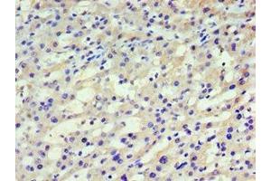 Immunohistochemistry of paraffin-embedded human liver cancer using ABIN7155257 at dilution of 1:100 (HARS1/Jo-1 antibody  (AA 1-180))