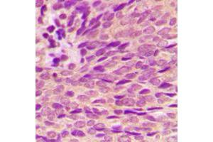 Immunohistochemical analysis of Estrogen Receptor alpha (pS118) staining in human breast cancer formalin fixed paraffin embedded tissue section. (Estrogen Receptor alpha antibody  (pSer118))