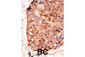Formalin-fixed and paraffin-embedded human cancer tissue reacted with the APOBEC3G polyclonal antibody  , which was peroxidase-conjugated to the secondary antibody, followed by DAB staining. (APOBEC3G antibody  (C-Term))