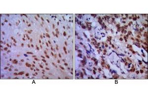 Immunohistochemical analysis of paraffin-embedded human lung cancer (A) and esophageal cancer (B), showing cytoplasmic localization using CDC2 mouse mAb with DAB staining. (CDK1 antibody)