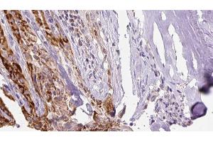 ABIN6267132 at 1/100 staining Human thyroid cancer tissue by IHC-P. (KSR1 antibody  (pSer40, pSer392))