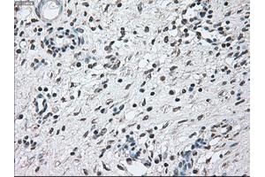 Immunohistochemical staining of paraffin-embedded Adenocarcinoma of breast tissue using anti-BRAF mouse monoclonal antibody. (BRAF antibody)