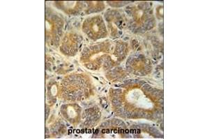 CRABP1 Antibody (C-term) (ABIN651614 and ABIN2840325) immunohistochemistry analysis in formalin fixed and paraffin embedded human prostate carcinoma followed by peroxidase conjugation of the secondary antibody and DAB staining. (CRABP1 antibody  (C-Term))