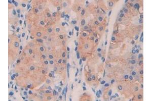 IHC-P analysis of Human Stomach cancer Tissue, with DAB staining. (ANGPTL4 antibody  (AA 182-388))
