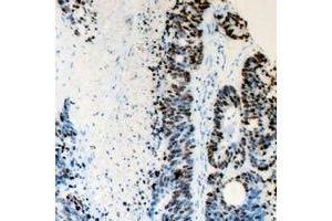 Immunohistochemical analysis of FANCD2 staining in human colon cancer formalin fixed paraffin embedded tissue section.