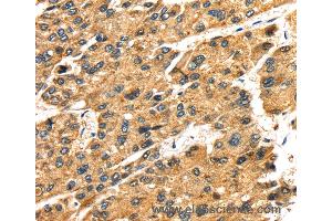 Immunohistochemistry of Human liver cancer using SLC25A26 Polyclonal Antibody at dilution of 1:30