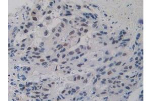 IHC-P analysis of Human Breast Cancer Tissue, with DAB staining. (Nucleolin antibody  (AA 388-569))