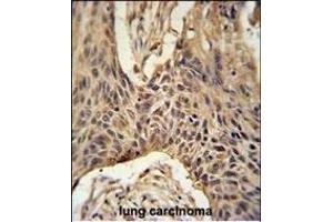 LR4 Antibody (C-term) (ABIN651164 and ABIN2840106) immunohistochemistry analysis in formalin fixed and paraffin embedded human lung carcinoma followed by peroxidase conjugation of the secondary antibody and DAB staining. (LPPR4 antibody  (C-Term))