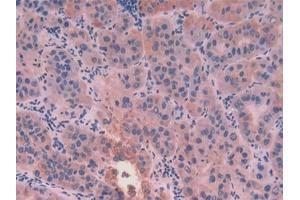 Detection of CK8 in Human Liver cancer Tissue using Polyclonal Antibody to Cytokeratin 8 (CK8) (KRT8 antibody  (AA 92-393))