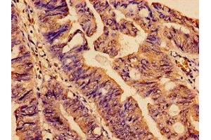 Immunohistochemistry analysis of human colon cancer using ABIN7170866 at dilution of 1:100 (SMC4 antibody  (AA 406-501))