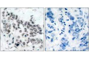 Immunohistochemistry analysis of paraffin-embedded human breast carcinoma, using Retinoblastoma (Phospho-Ser780) Antibody.