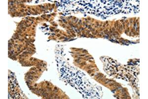 The image on the left is immunohistochemistry of paraffin-embedded Human colon cancer tissue using ABIN7130641(PIWIL4 Antibody) at dilution 1/25, on the right is treated with fusion protein. (PIWIL4 antibody)