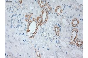 Immunohistochemical staining of paraffin-embedded Carcinoma of kidney tissue using anti-KRT19mouse monoclonal antibody. (Cytokeratin 19 antibody  (AA 240-390))