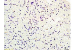 Formalin-fixed and human glioma tissue labeled with Anti-USP-1 Polyclonal Antibody, Unconjugated  at 1:200 followed by conjugation to the secondary antibody and DAB staining (USP1 antibody  (AA 701-785))