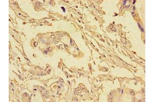 Immunohistochemistry of paraffin-embedded human pancreatic cancer using ABIN7152193 at dilution of 1:100 (eIF4EBP1 antibody  (AA 2-111))
