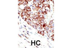 Formalin-fixed and paraffin-embedded human cancer tissue reacted with the primary antibody, which was peroxidase-conjugated to the secondary antibody, followed by DAB staining. (PIAS1 antibody  (C-Term))