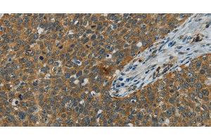 Immunohistochemistry of paraffin-embedded Human cervical cancer using E2F6 Polyclonal Antibody at dilution of 1:60 (E2F6 antibody)