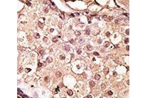 IHC analysis of FFPE human breast carcinoma tissue stained with the ACE2 antibody (ACE2 antibody  (AA 140-172))