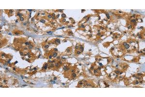 Immunohistochemistry of paraffin-embedded Human thyroid cancer using RAP1B Polyclonal Antibody at dilution of 1:50