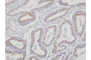 IHC-P Image Immunohistochemical analysis of paraffin-embedded human endometrial cancer, using YIPF4, antibody at 1:500 dilution. (YIPF4 antibody)