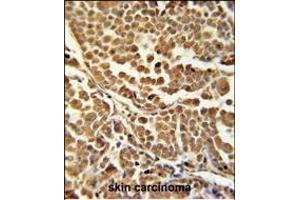 ZN Antibody (C-term) (ABIN651881 and ABIN2840437) immunohistochemistry analysis in formalin fixed and paraffin embedded human skin carcinoma followed by peroxidase conjugation of the secondary antibody and DAB staining. (RNF114 antibody  (C-Term))